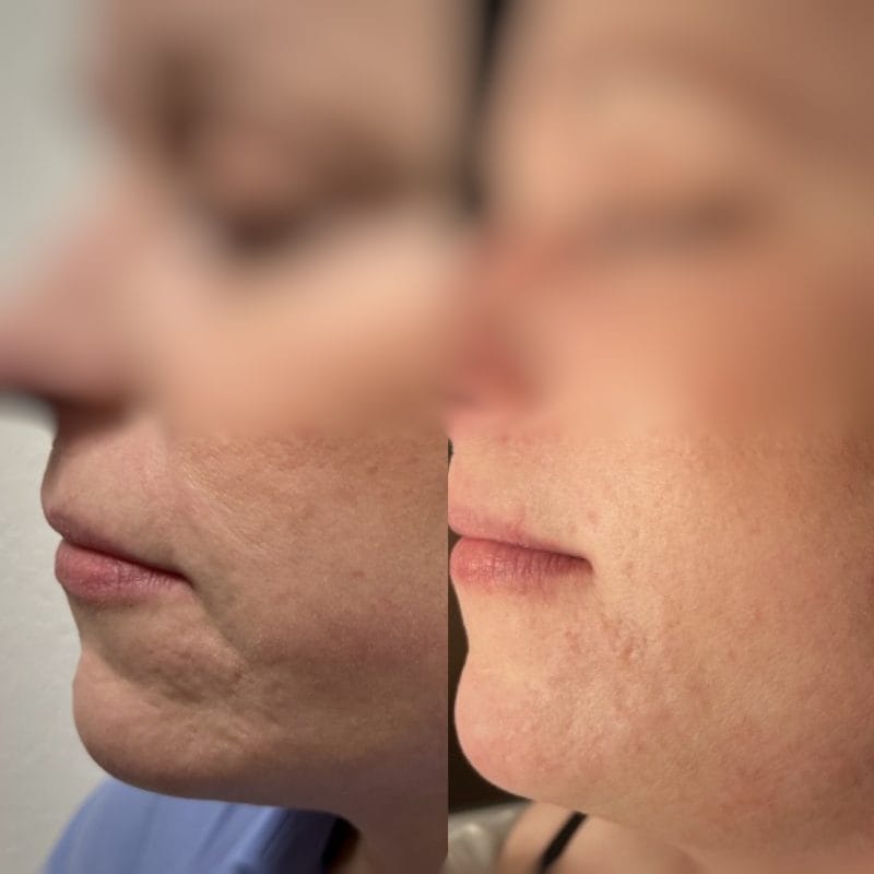 Før & efter billeder af vores virtuel konsultation og unikke Dermapen PRO behandlinger