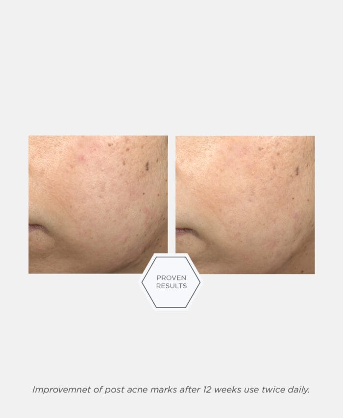 Neostrata Post-Acne Mark Correcting Serum 30 ml - Billede 5