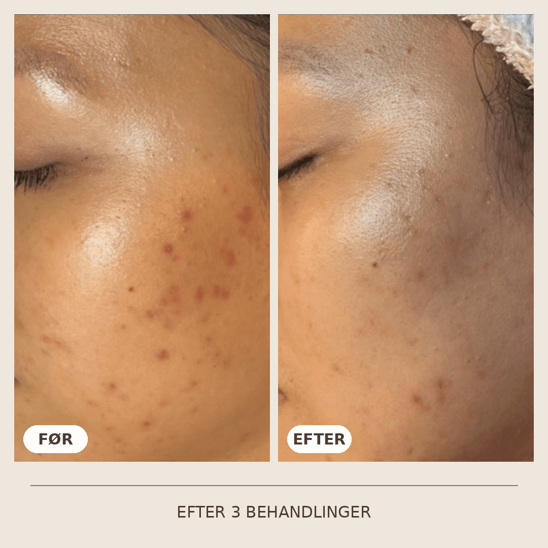 01_SkinPen_3_behandlinger
