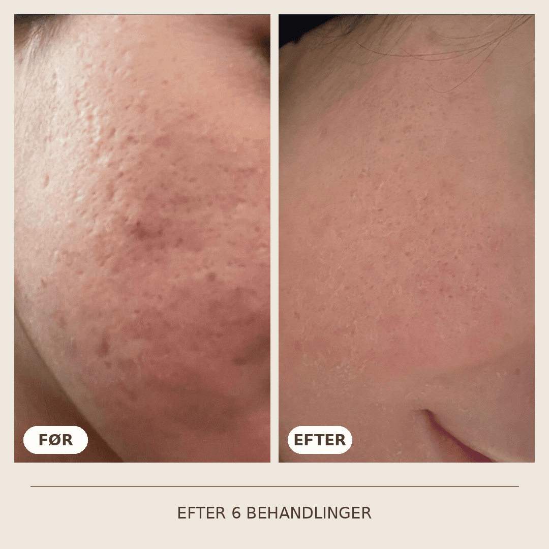 02_SkinPen_6_behandlinger