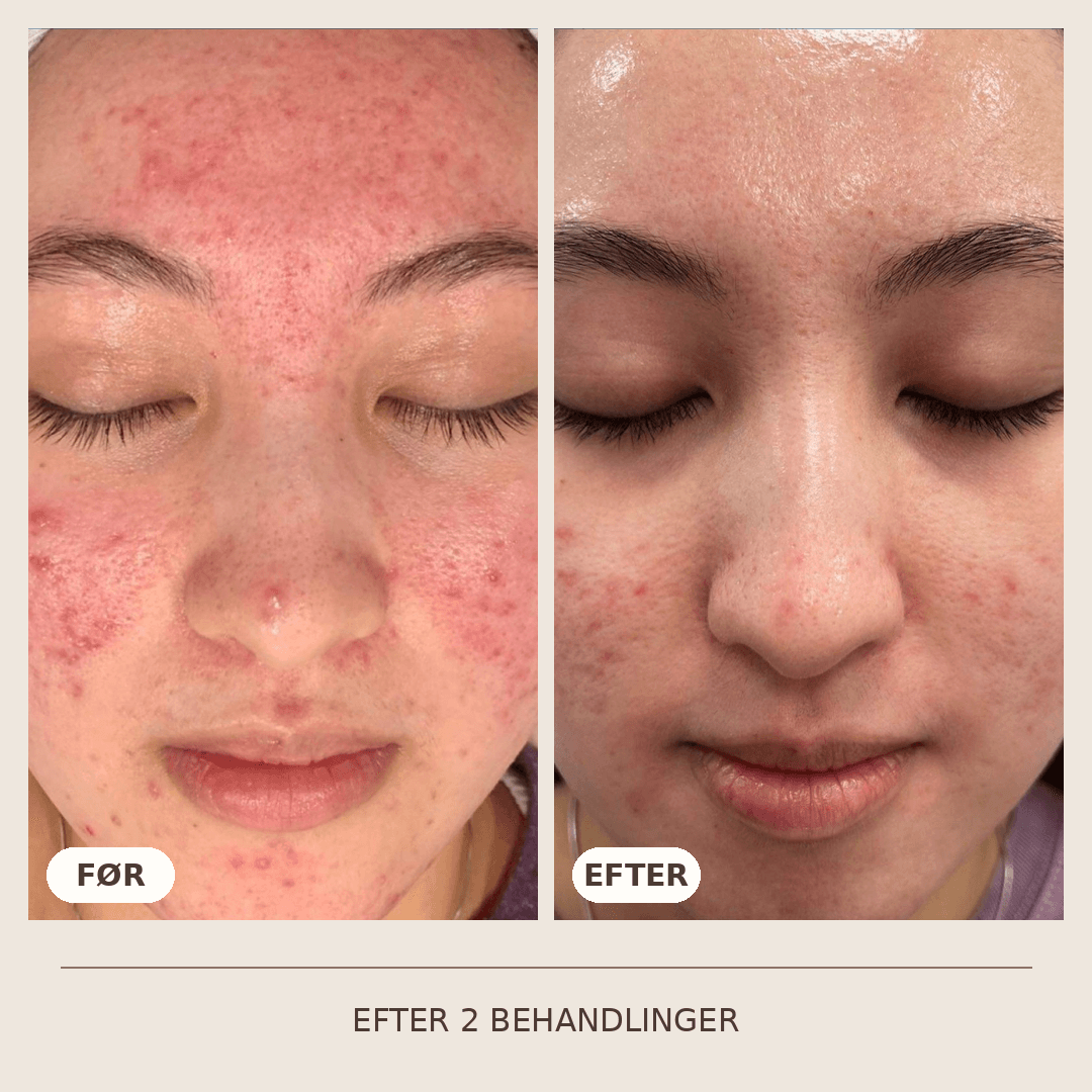03_SkinPen_2_behandlinger