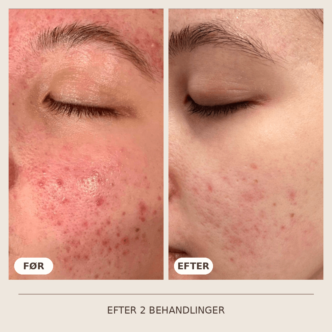 04_SkinPen_2_behandlinger