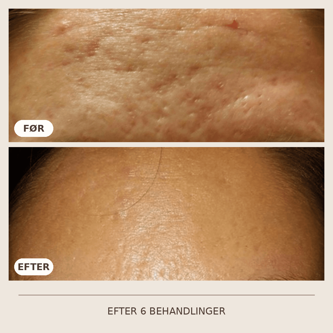 05_SkinPen_6_behandlinger