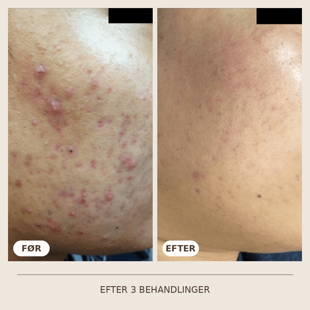 06_SkinPen_3_behandlinger