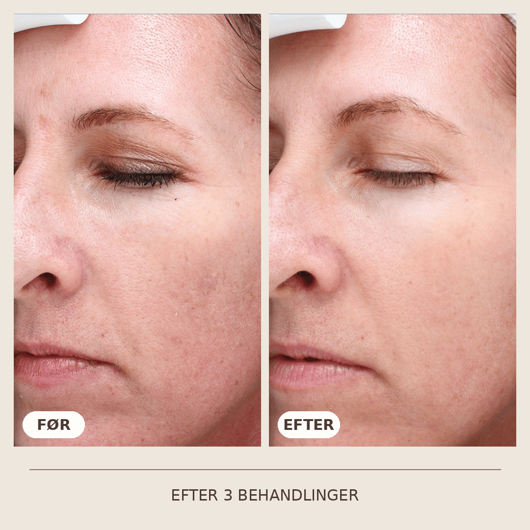 07_SkinPen_3_behandlinger
