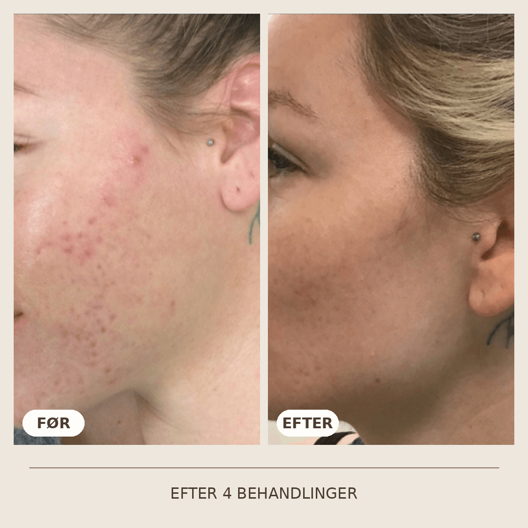 08_SkinPen_4_behandlinger