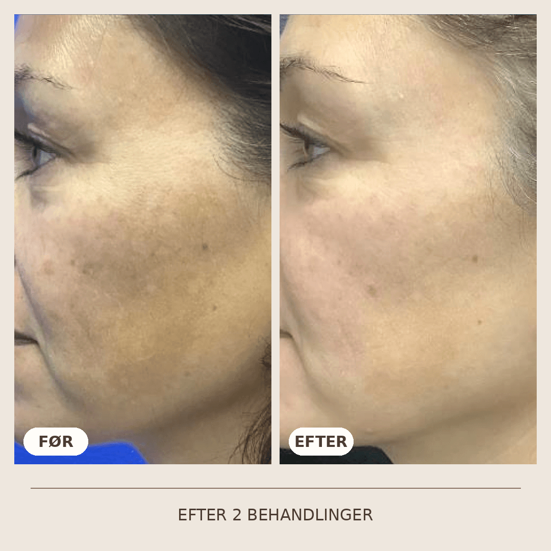 09_SkinPen_2_behandlinger