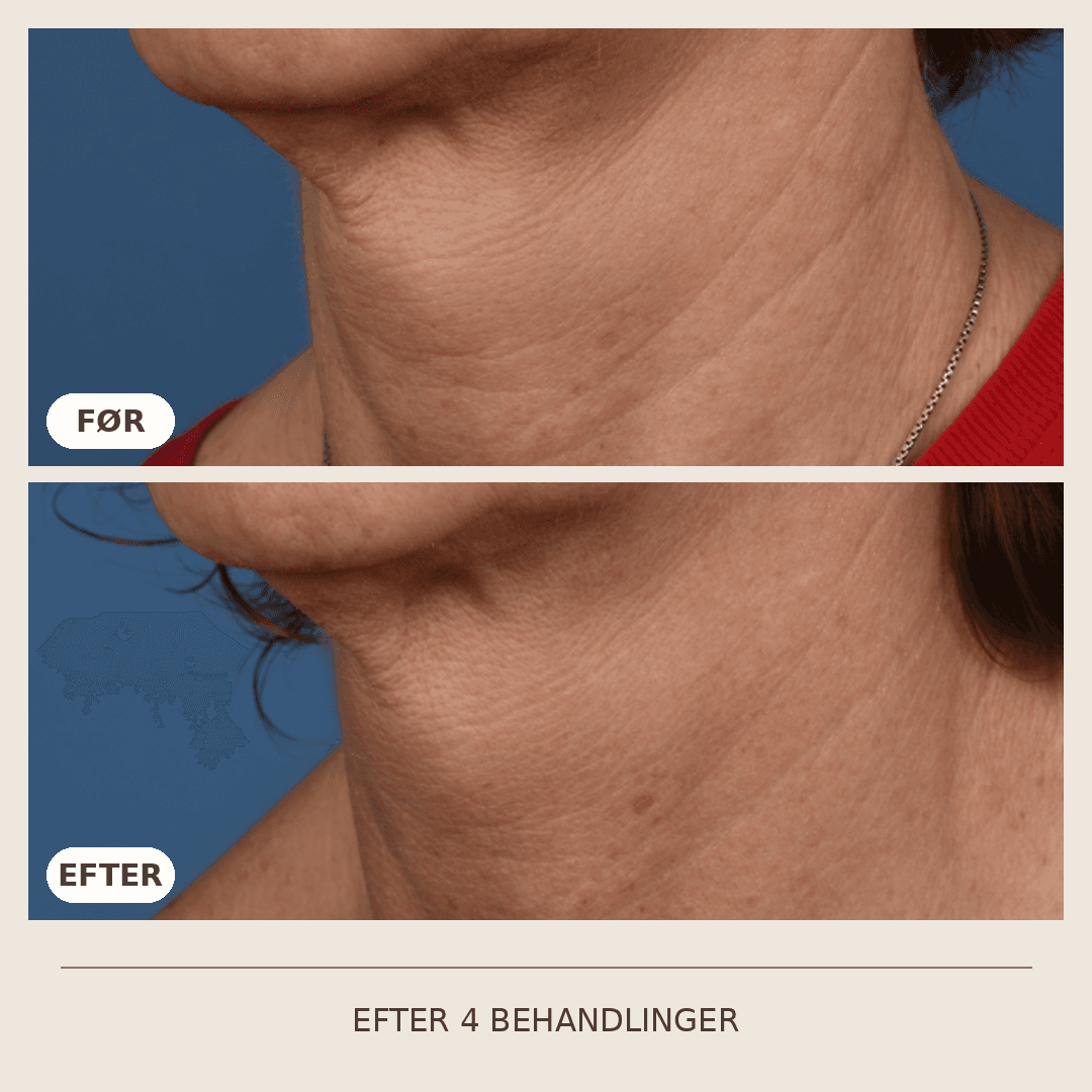 10_SkinPen_4_behandlinger