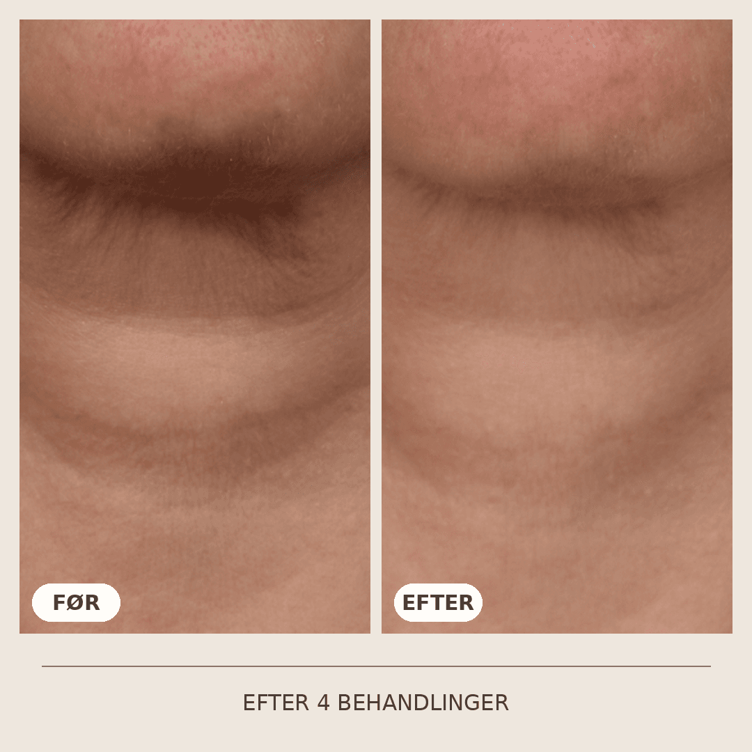 11_SkinPen_4_behandlinger