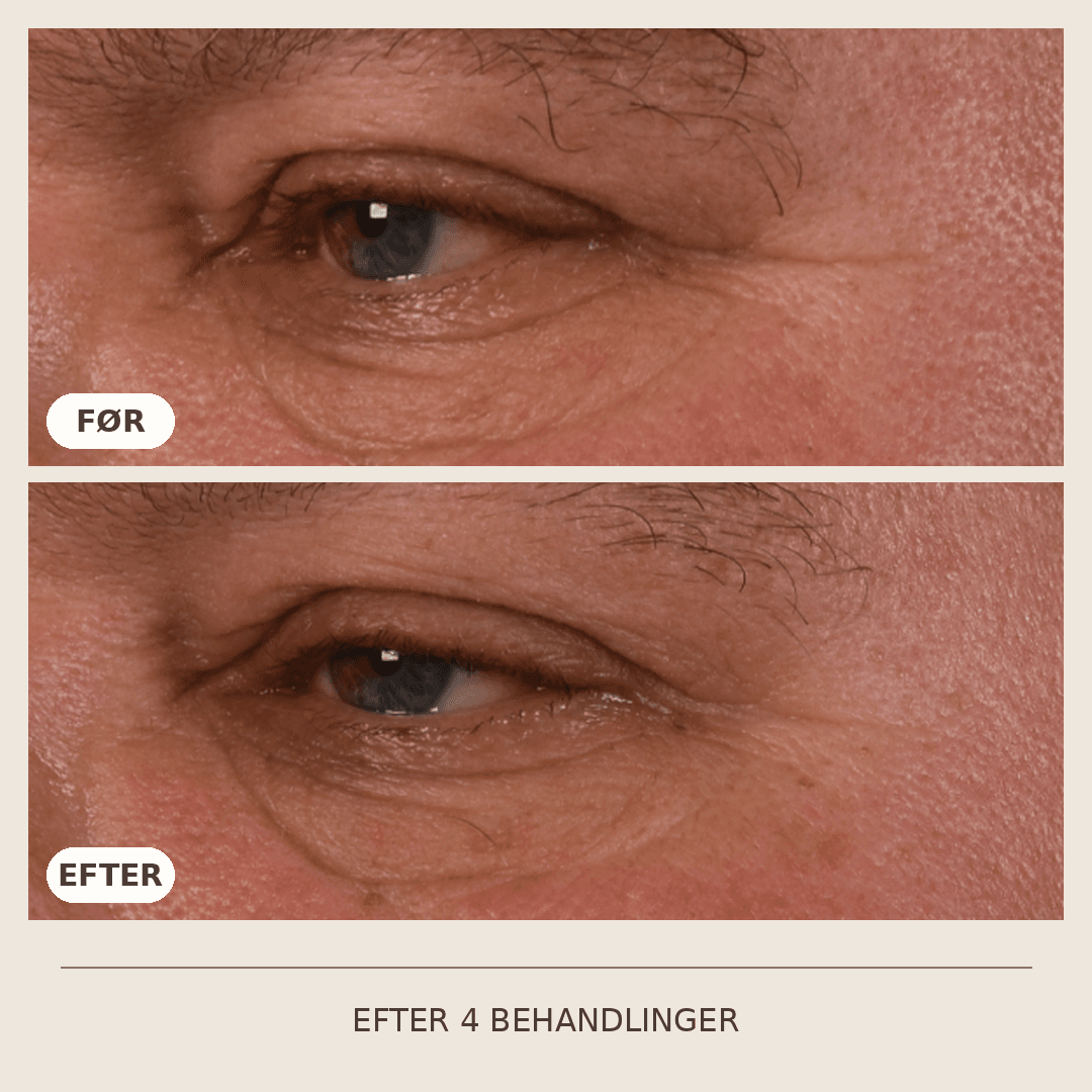 12_SkinPen_4_behandlinger