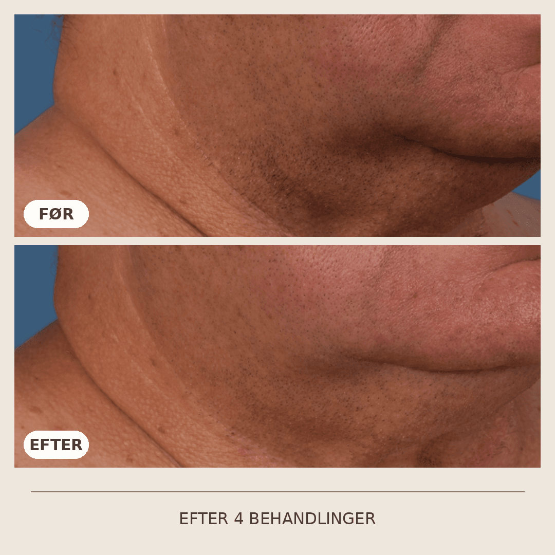 13_SkinPen_4_behandlinger