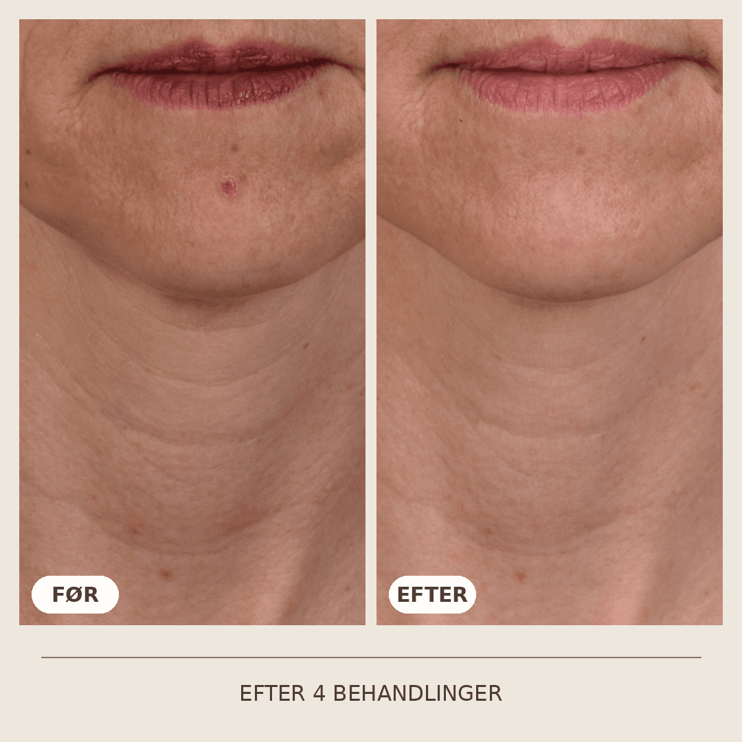 14_SkinPen_4_behandlinger