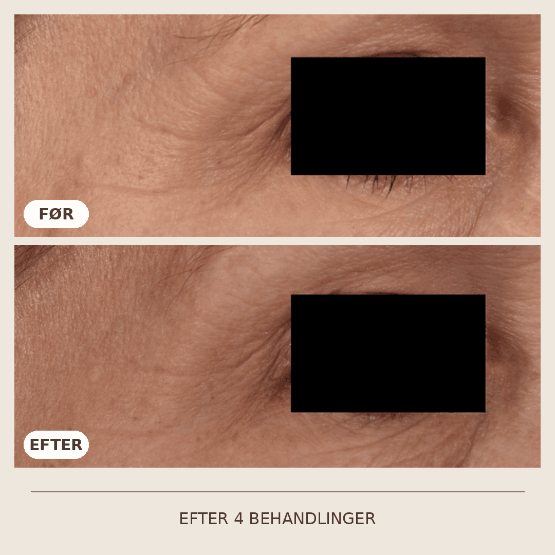 15_SkinPen_4_behandlinger