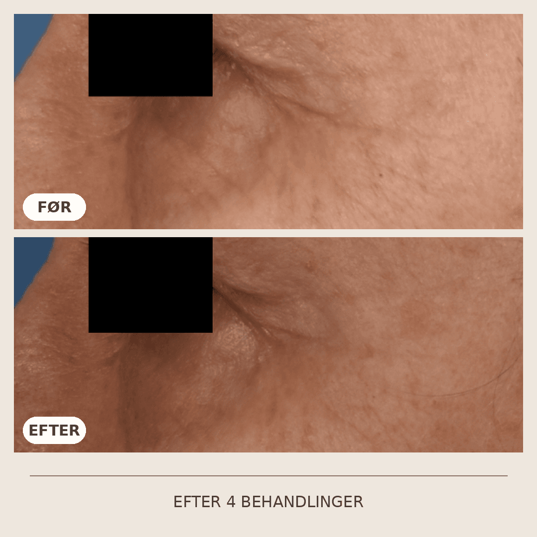 16_SkinPen_4_behandlinger