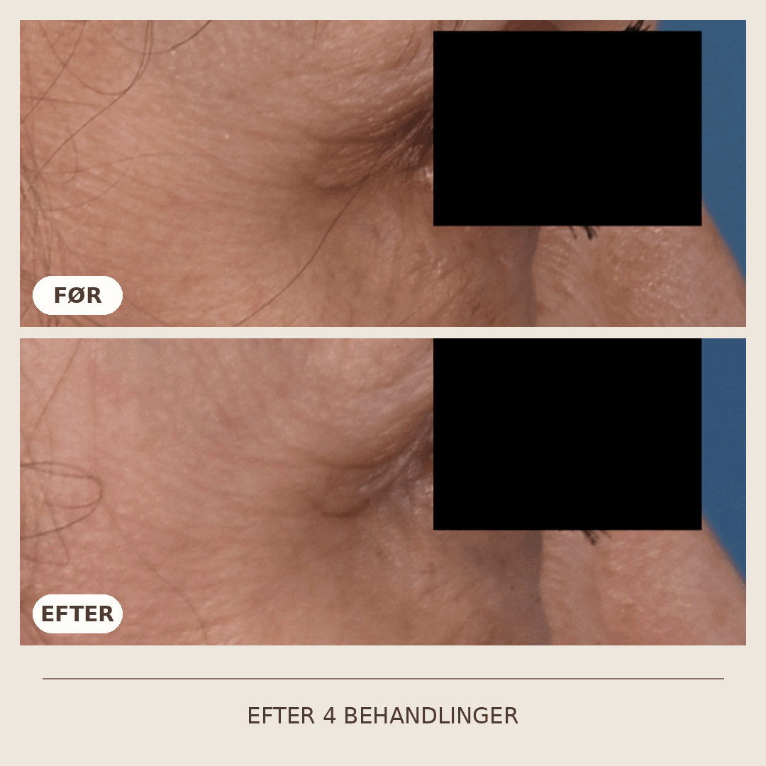 17_SkinPen_4_behandlinger