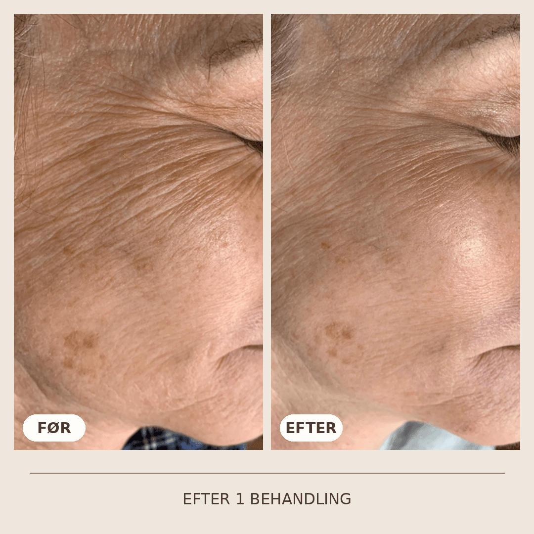 18_SkinPen_1_behandling