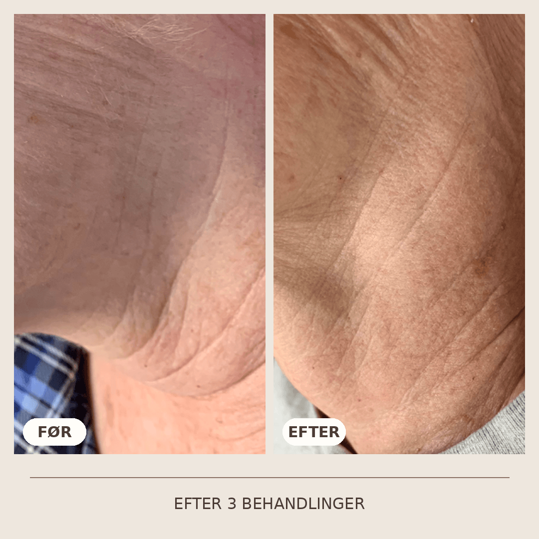 19_SkinPen_3_behandlinger