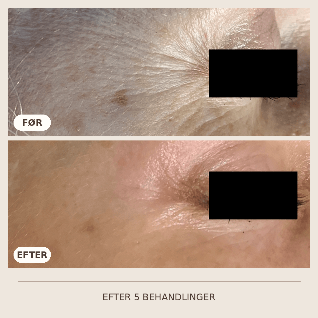 20_SkinPen_5_behandlinger