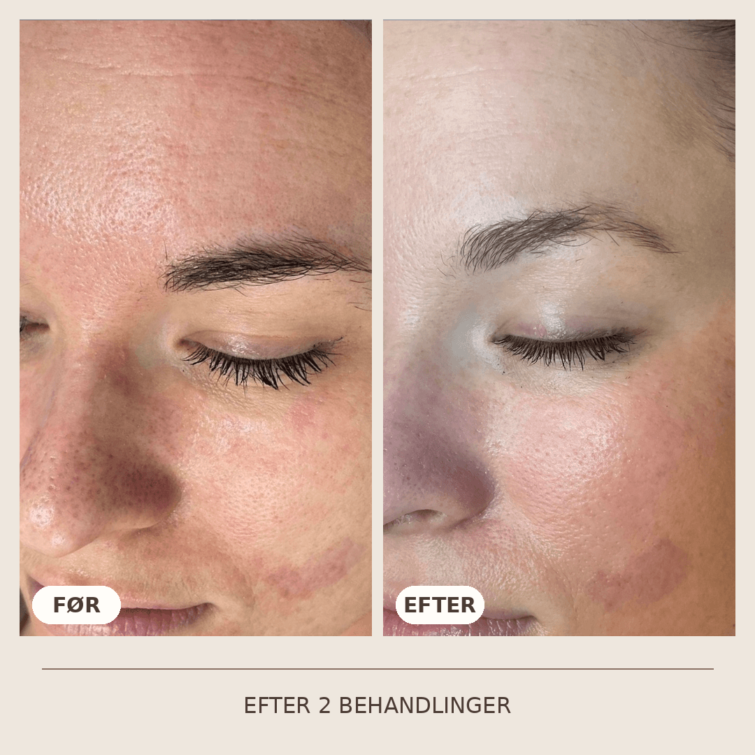 21_SkinPen_2_behandlinger