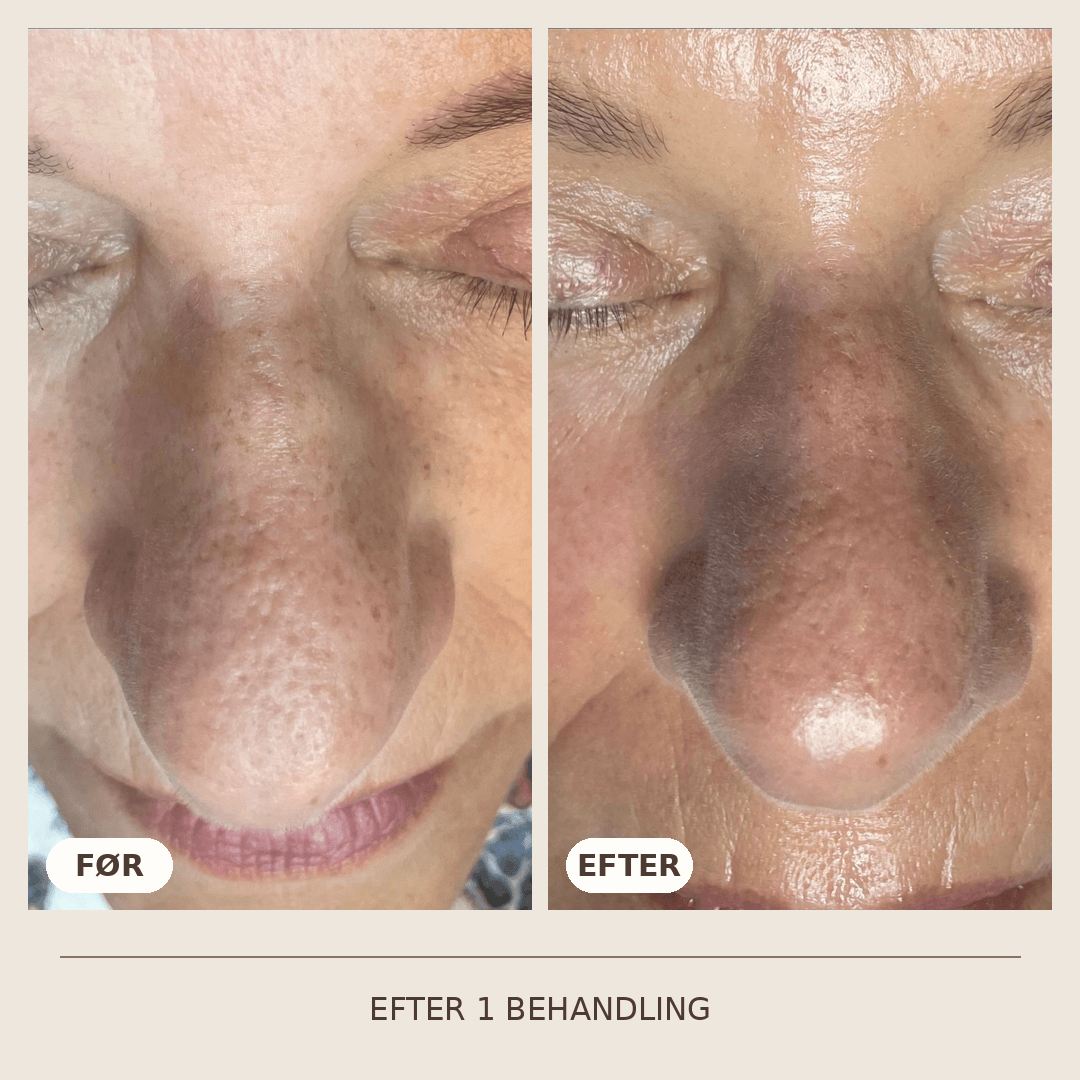22_SkinPen_1_behandling
