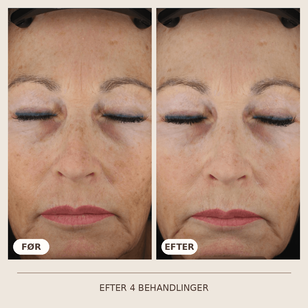 23_SkinPen_4_behandlinger