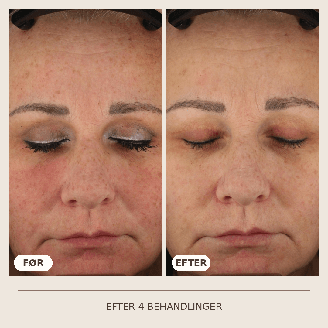 24_SkinPen_4_behandlinger
