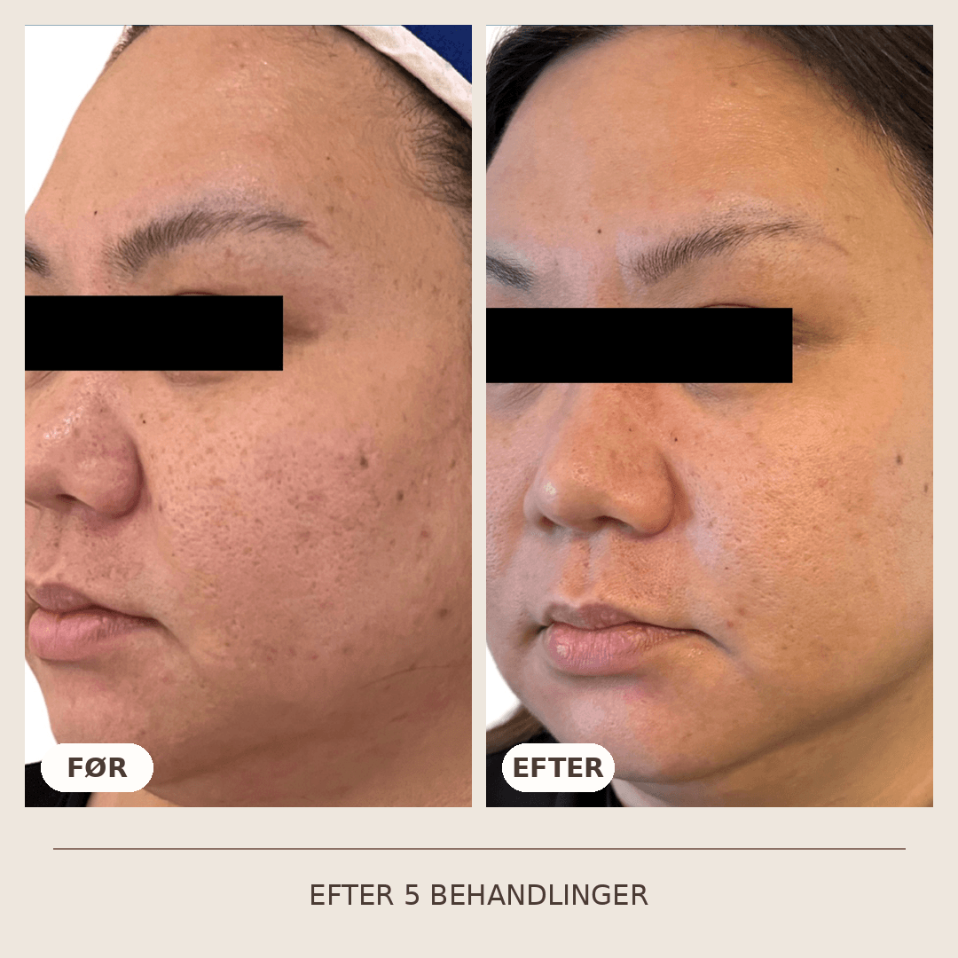 28_SkinPen_5_behandlinger