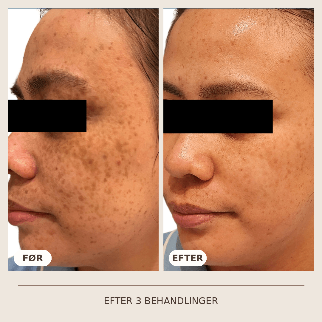 31_SkinPen_3_behandlinger