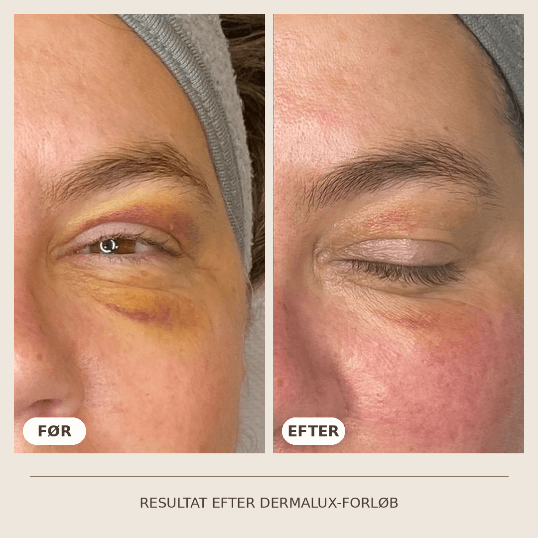36_Dermalux