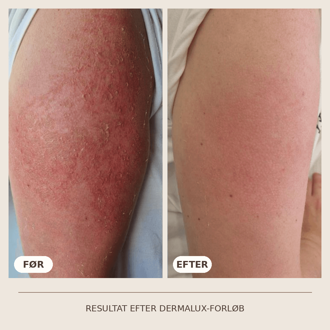 37_Dermalux